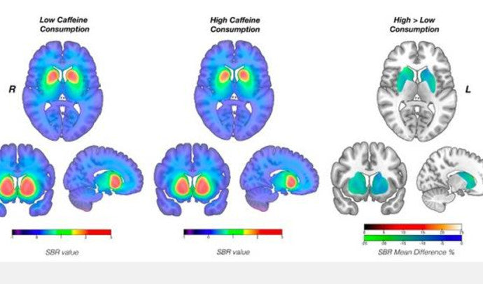 Unlocking Coffee's Impact on Parkinson's Disease - Surprising Insights