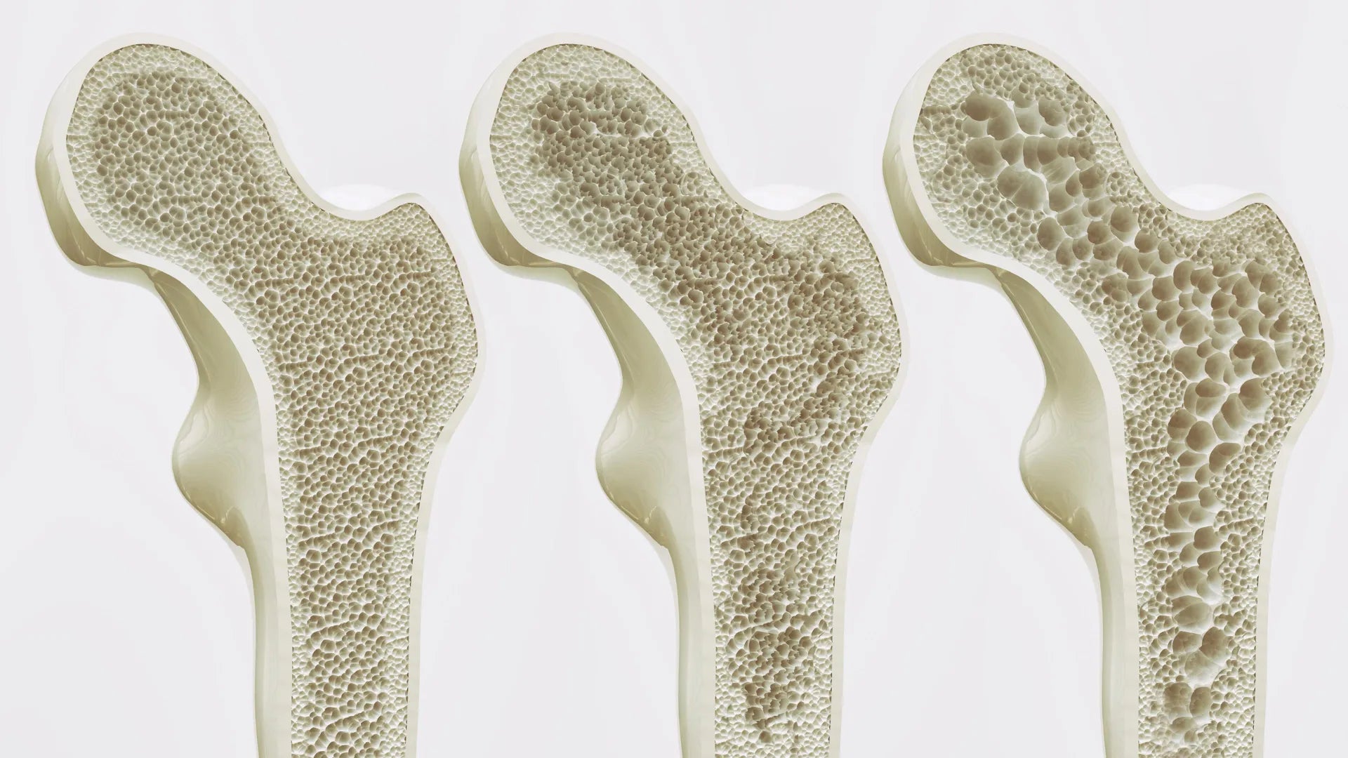Coffee vs. Tea - What’s Best for Bone Health in Older Women?